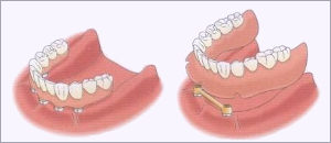 Implantologia Rzeszów - Odbudowa zębów bezzębia