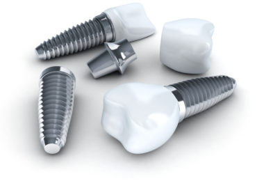 Implanty Rzeszów - leczenie implantologiczne Rzeszów implanty